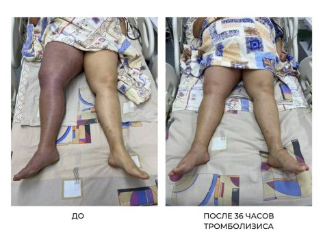 Врачи Нижневартовска прооперировали женщину с опасной венозной гангреной