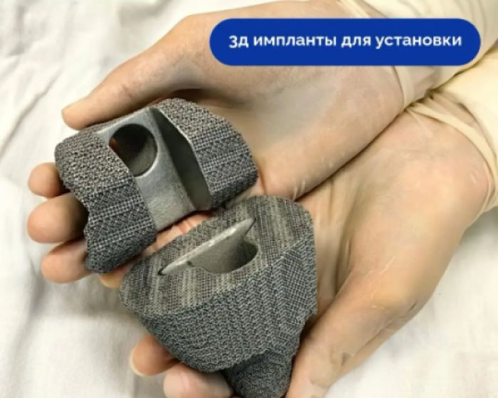 Сургутские врачи восстановили коленный сустав пациентки с помощью 3D-имплантов